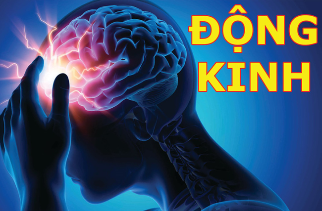 Bệnh động kinh: Cách nhận biết, nguyên nhân và xử trí